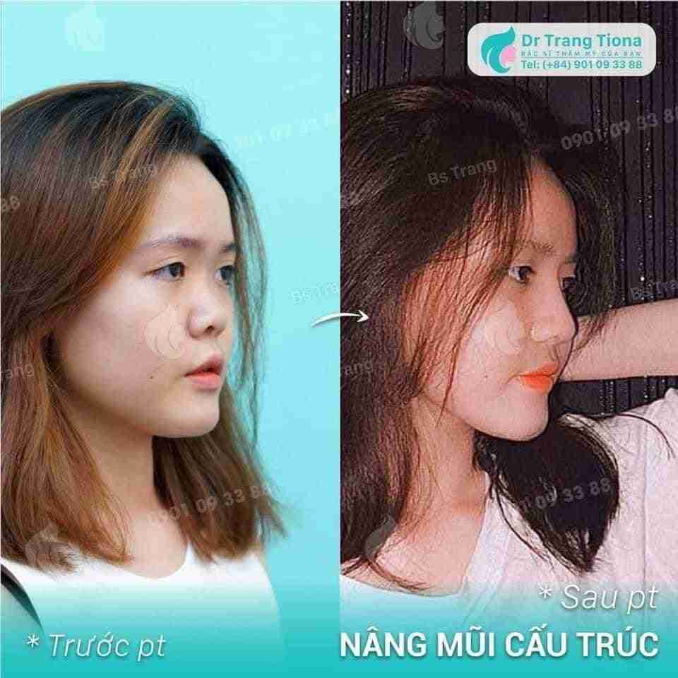 Có nên vừa nâng mũi vừa độn cằm cùng lúc không?