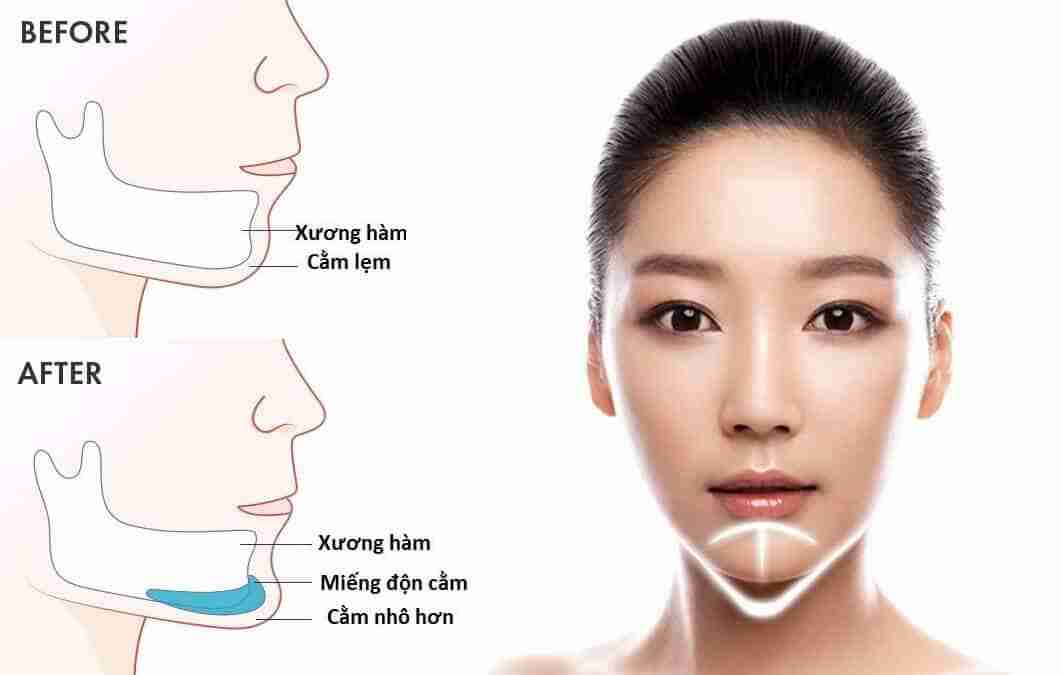 Có nên vừa nâng mũi vừa độn cằm cùng lúc không?