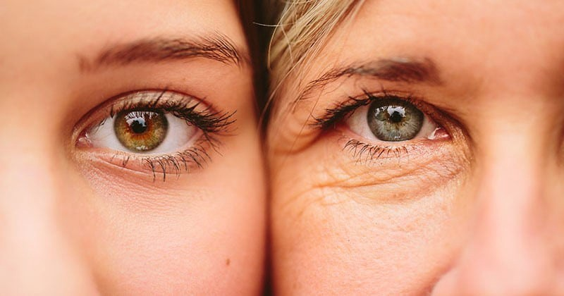 Có nên xóa rãnh lệ bằng phẫu thuật thẩm mỹ không?