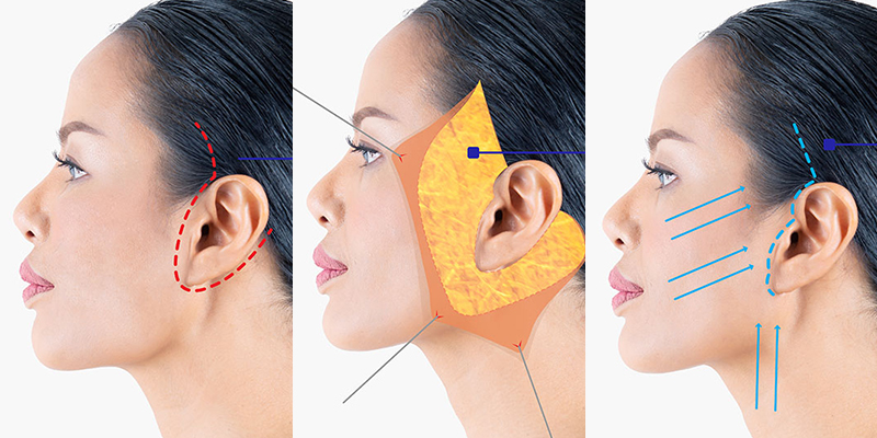 Phân Biệt Căng Da Mặt Truyền Thống Và Công Nghệ Căng Da Mặt 3SD