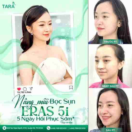 Công nghệ ERAS 5i phục hồi sớm. Nâng mũi ERAS 5i phục hồi sớm