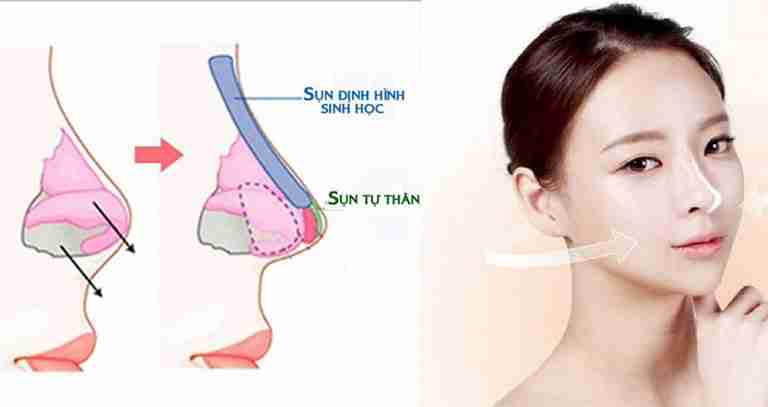 Da mũi mỏng có nâng mũi được không và chi phí