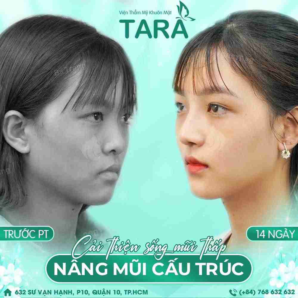 Bác sĩ giải đáp: Da mũi mỏng nâng mũi có nguy hiểm không