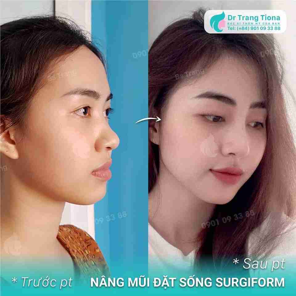 Dấu hiệu mũi bị tụt sụn: Hiểu rõ để ngăn ngừa đúng cách