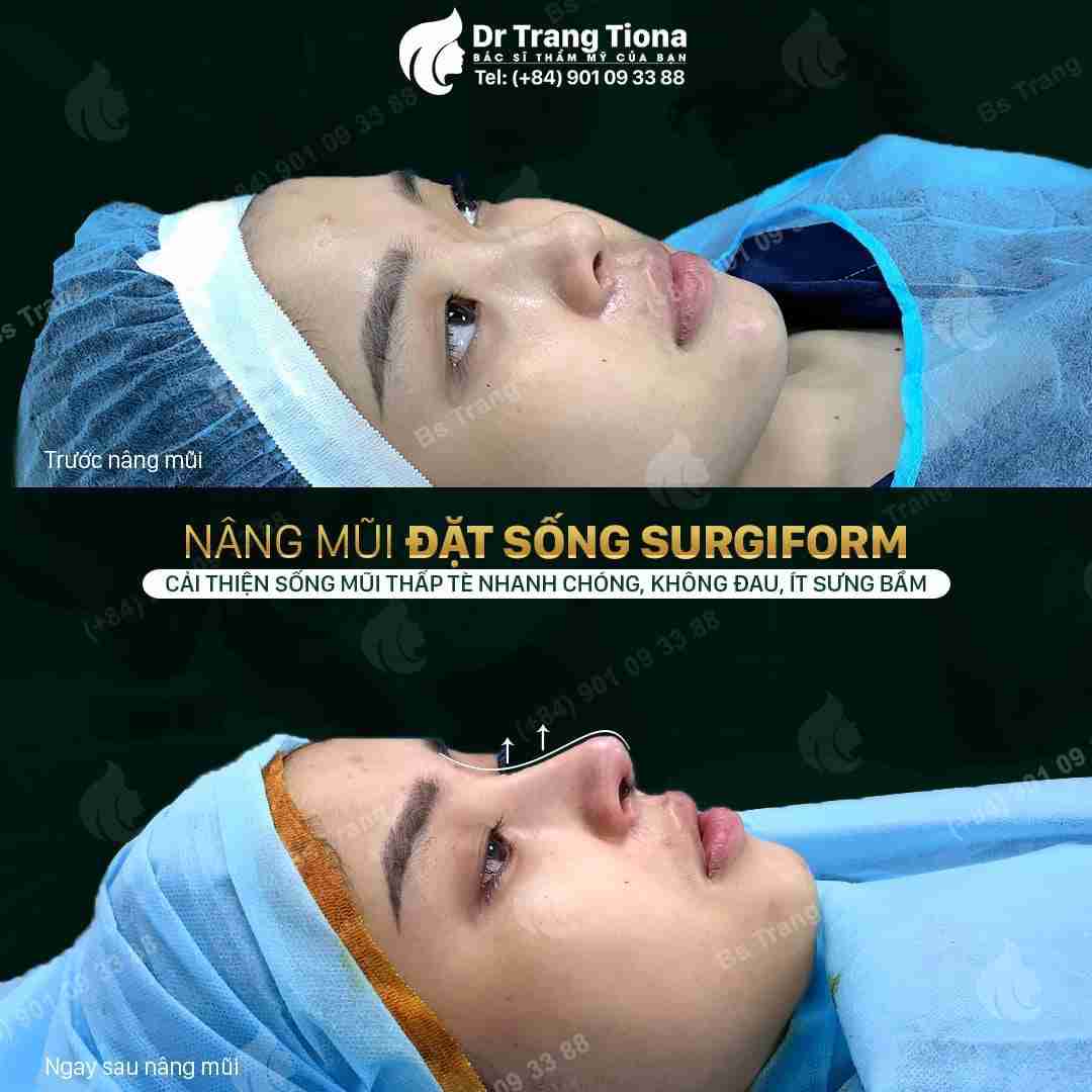 Nguyên nhân đầu mũi bị đỏ sau nâng mũi và cách xử lý