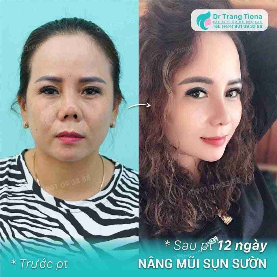 Nguyên nhân đầu mũi bị đỏ sau nâng mũi và cách xử lý