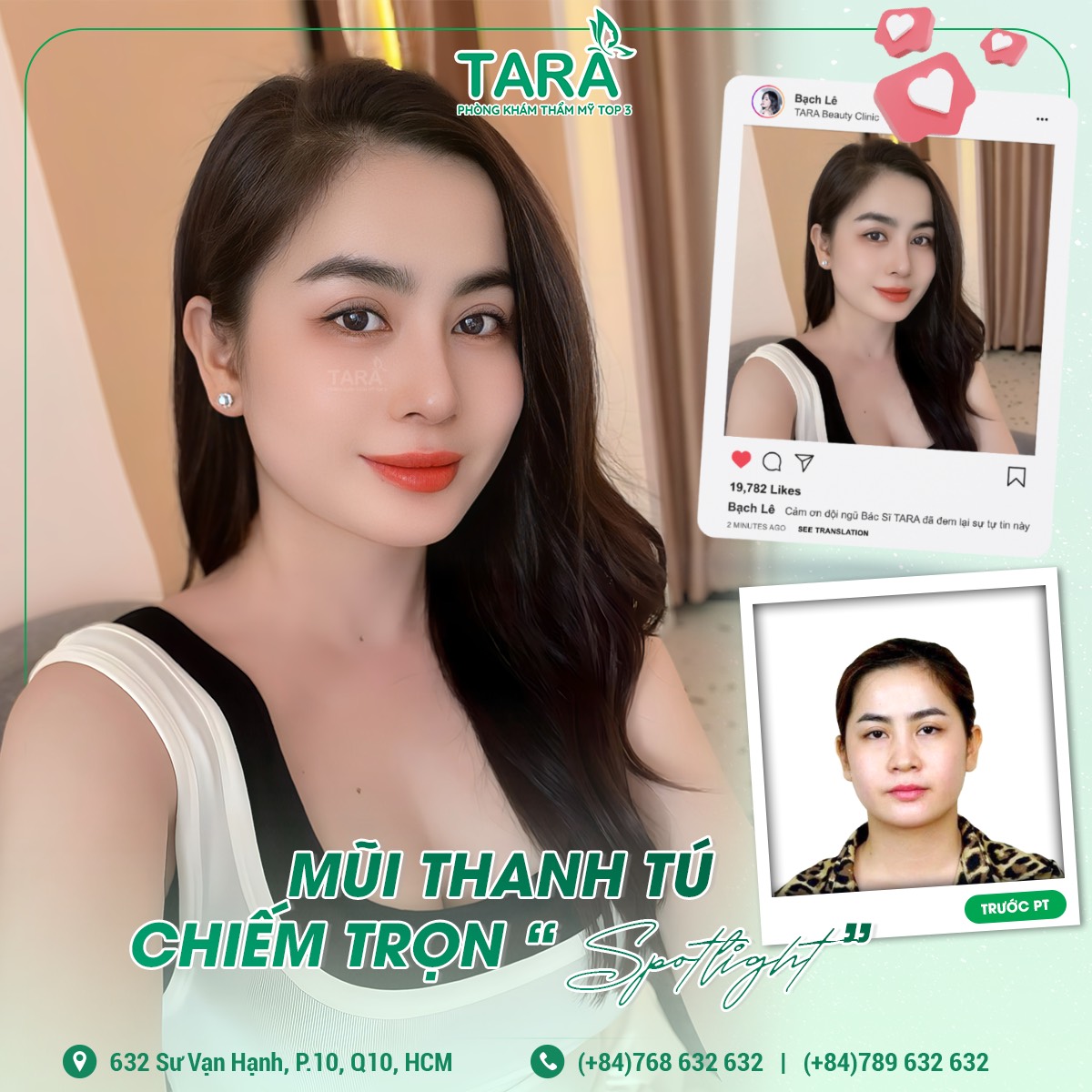 Địa chỉ nâng mũi ứng dụng đeo kính lúp siêu vi phẫu không đau uy tín tại TPHCM