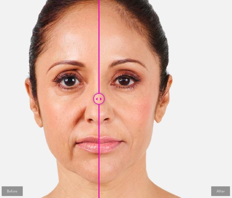 Địa chỉ tiêm filler Radiesse trẻ hoá uy tín tại Quận 10