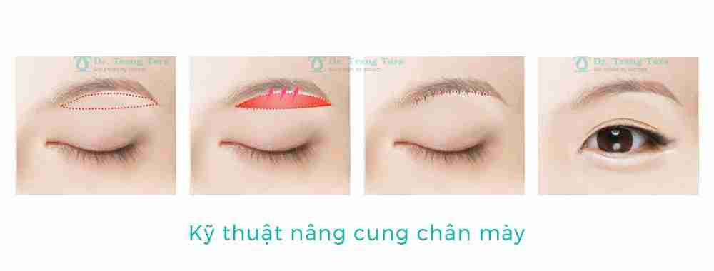 Tổng quan về nâng cung chân mày xóa tan sụp mí