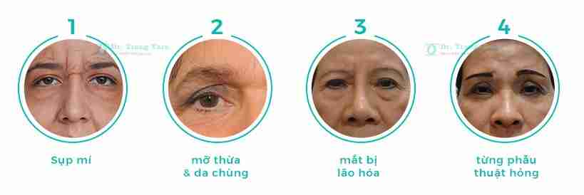 Tổng quan về nâng cung chân mày xóa tan sụp mí