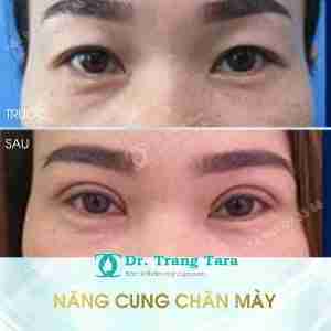 Tổng quan về nâng cung chân mày xóa tan sụp mí
