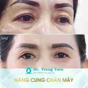 Tổng quan về nâng cung chân mày xóa tan sụp mí