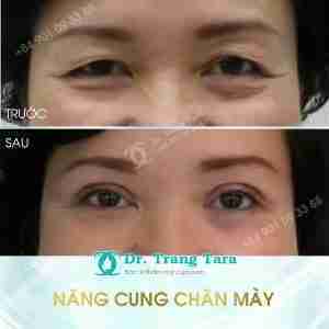Tổng quan về nâng cung chân mày xóa tan sụp mí