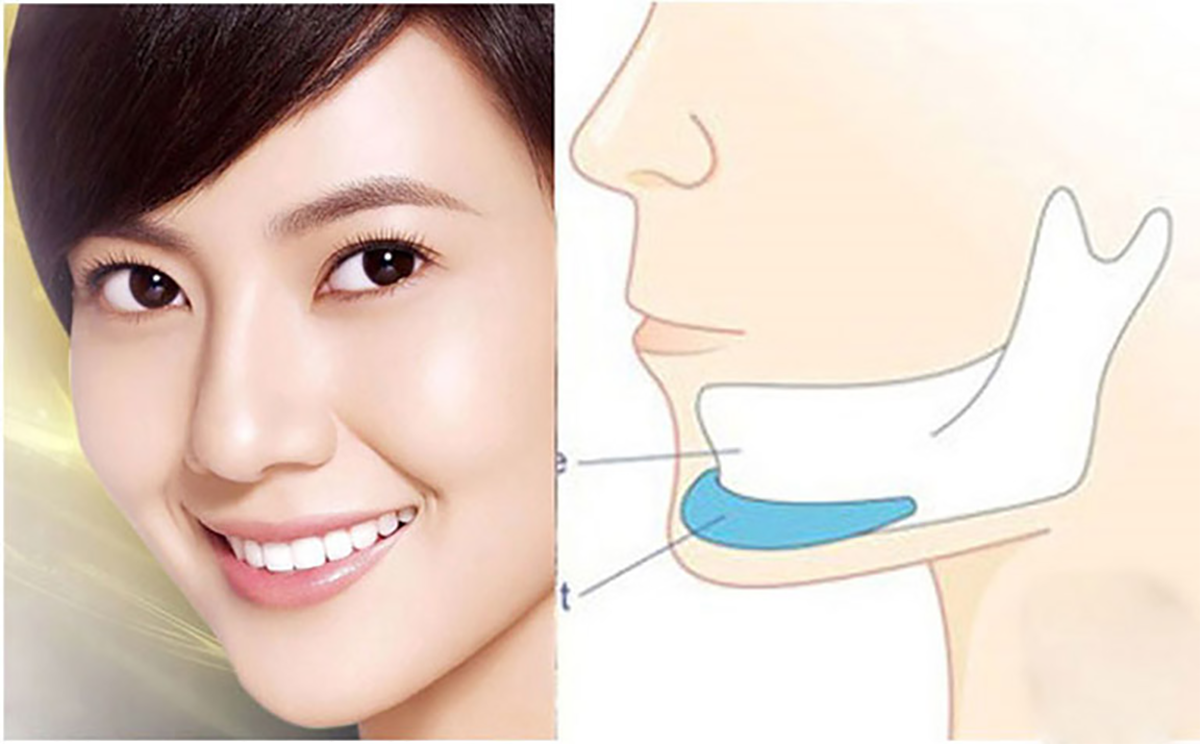 Độn cằm sụn Surgiform cho người mặt tròn, có nên không?