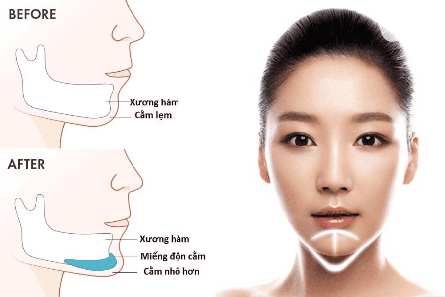 Giải đáp từ A-Z về độn cằm sụn Surgiform