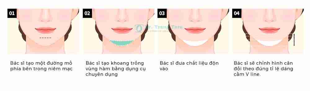 Tổng quan về độn cằm Vline