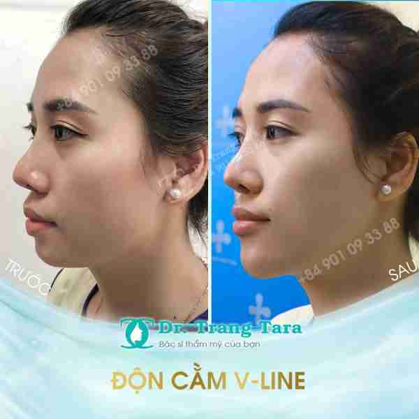 Tổng quan về độn cằm Vline