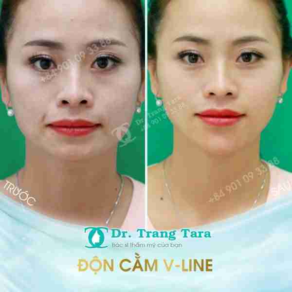 Tổng quan về độn cằm Vline