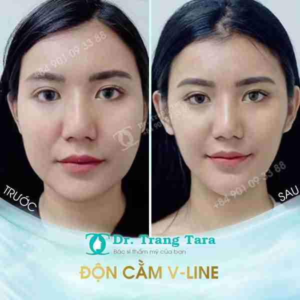 Tổng quan về độn cằm Vline