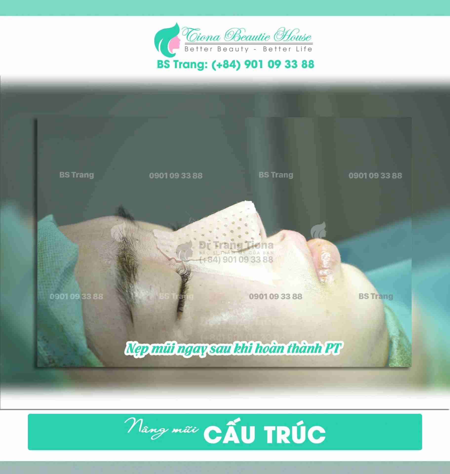 Đơn thuốc sau nâng mũi là gì? Uống trong bao lâu?