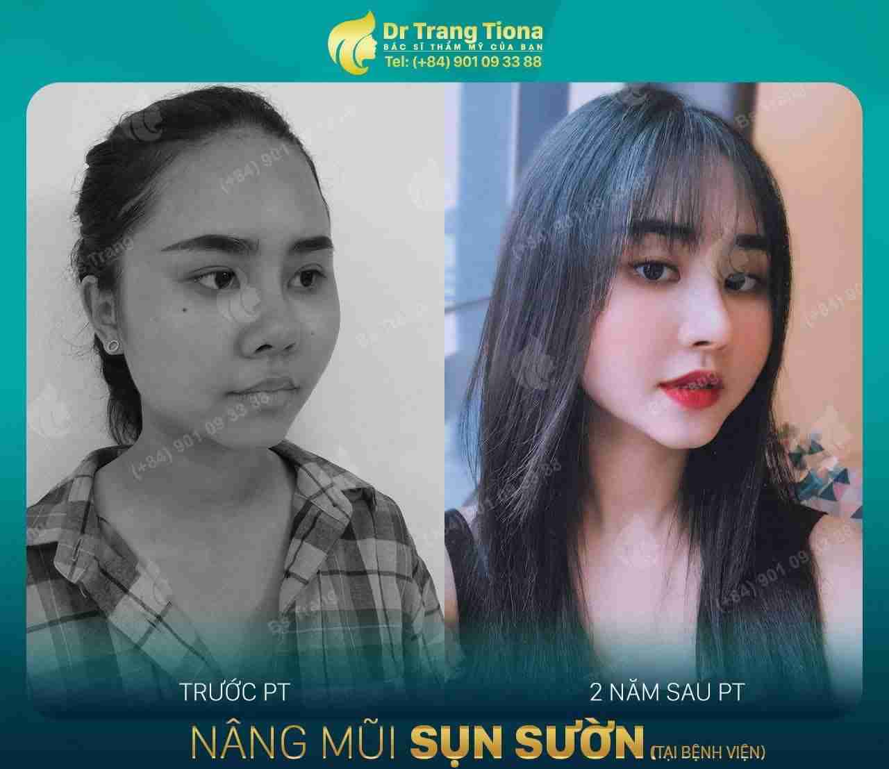 Giá 20 triệu có thực hiện nâng mũi cấu trúc được không?