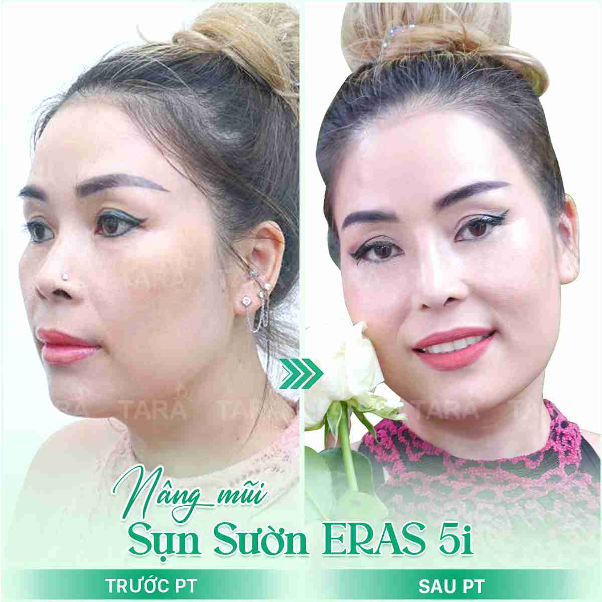 Sửa mũi hỏng giá bao nhiêu?