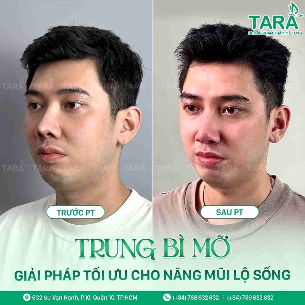 Sửa mũi hỏng giá bao nhiêu?