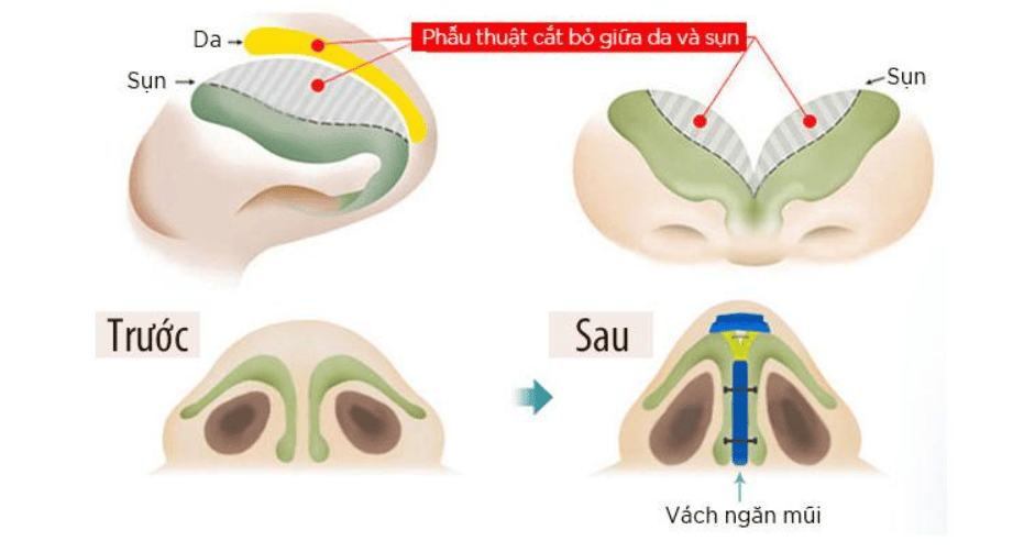 Giải đáp từ A-Z về nâng mũi bán cấu trúc dựng trụ