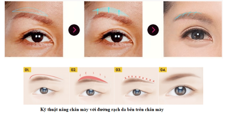 Giải đáp từ A-Z về phẫu thuật nâng cung chân mày