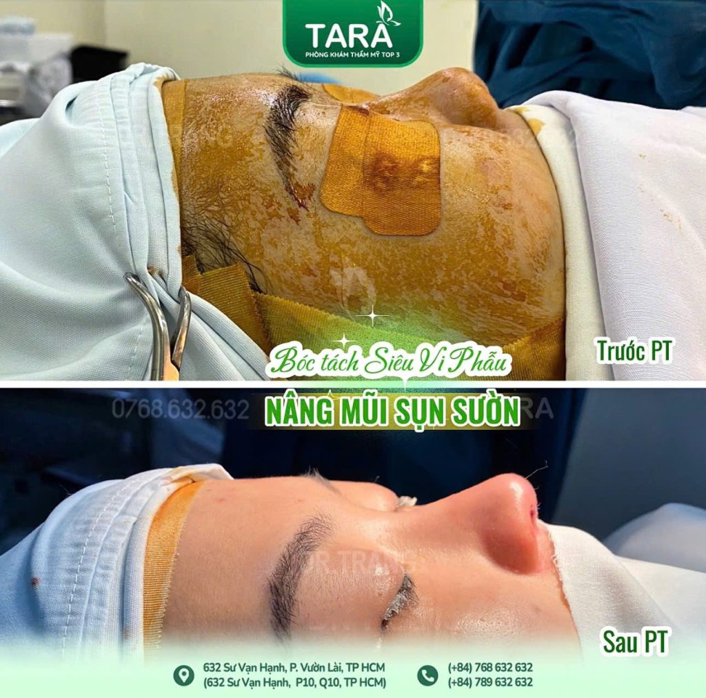 Giải mã ‘nâng mũi không đau’ và cách TS BS Trang TARA kiểm soát đau hiệu quả