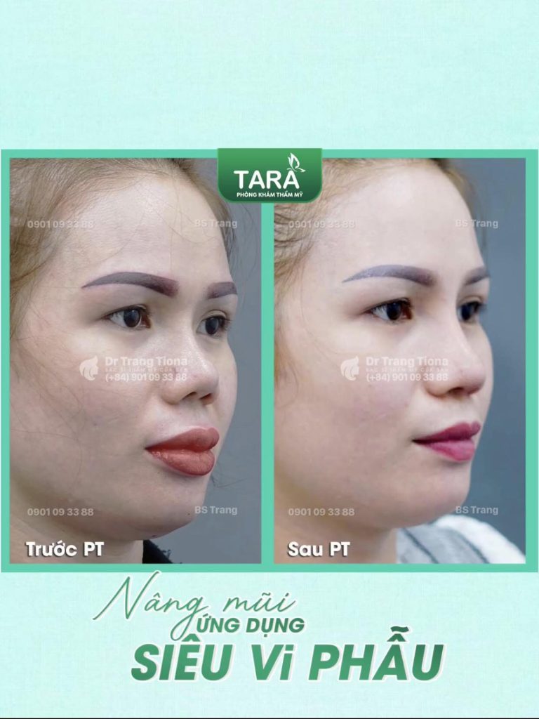 Giải mã ‘nâng mũi không đau’ và cách TS BS Trang TARA kiểm soát đau hiệu quả