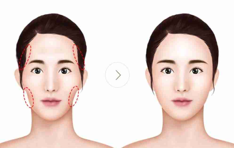Giải mã sự ưa chuộng của cấy mỡ mặt Babyface