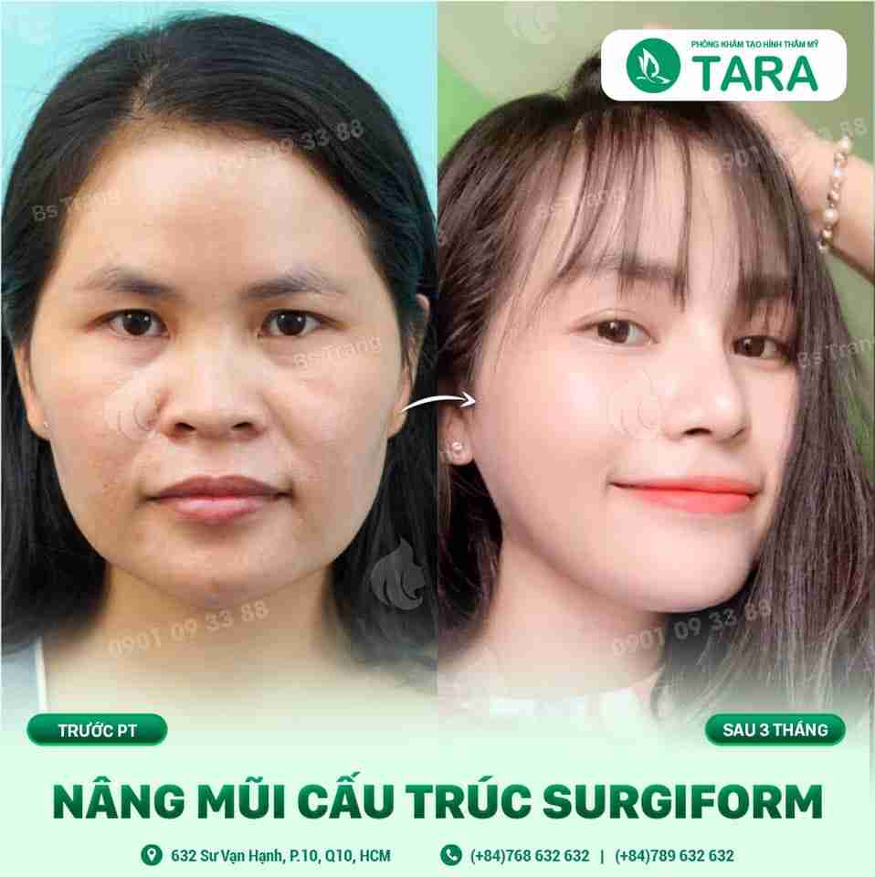 Gốc mũi quá cao sau nâng mũi có tự thấp xuống không?