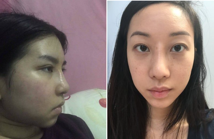 Gốc mũi quá cao sau nâng mũi có tự thấp xuống không?