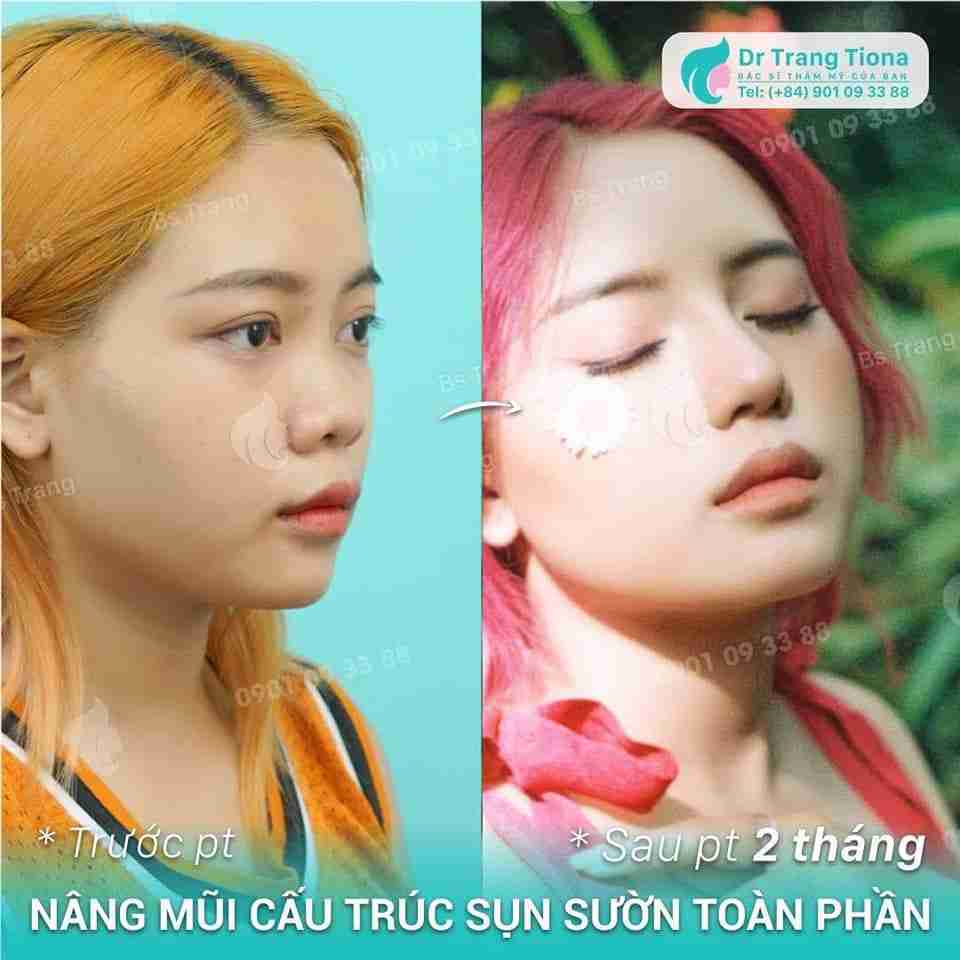 Gợi ý 6 cách làm mũi cao phổ biến hiện nay