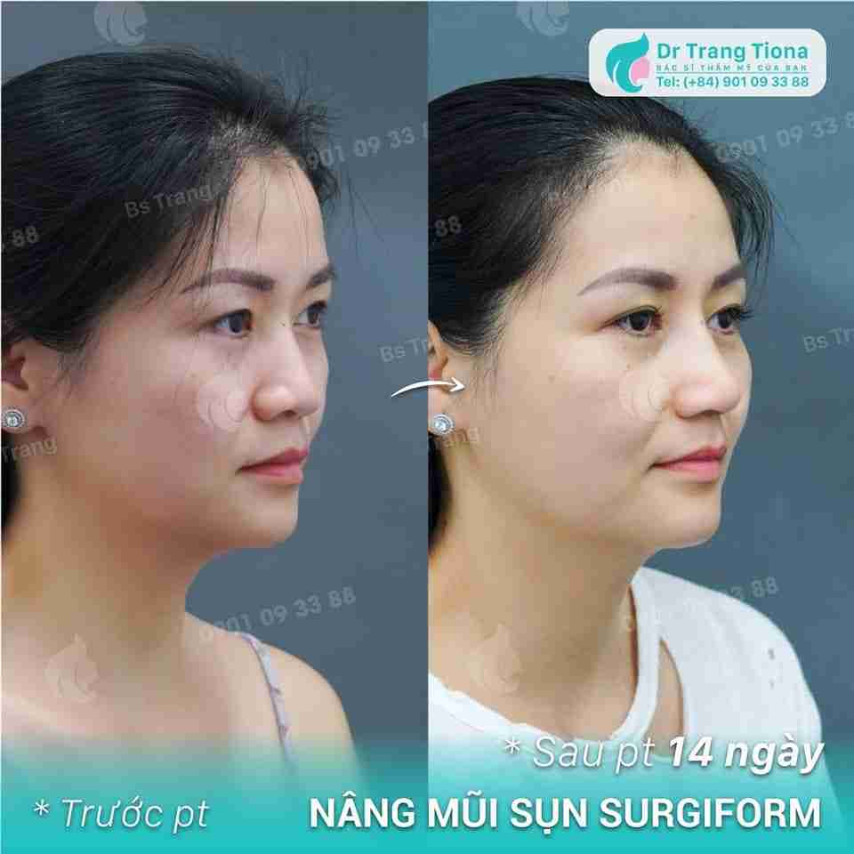 Hình ảnh nâng mũi cấu trúc sau 14 ngày trông như thế nào?