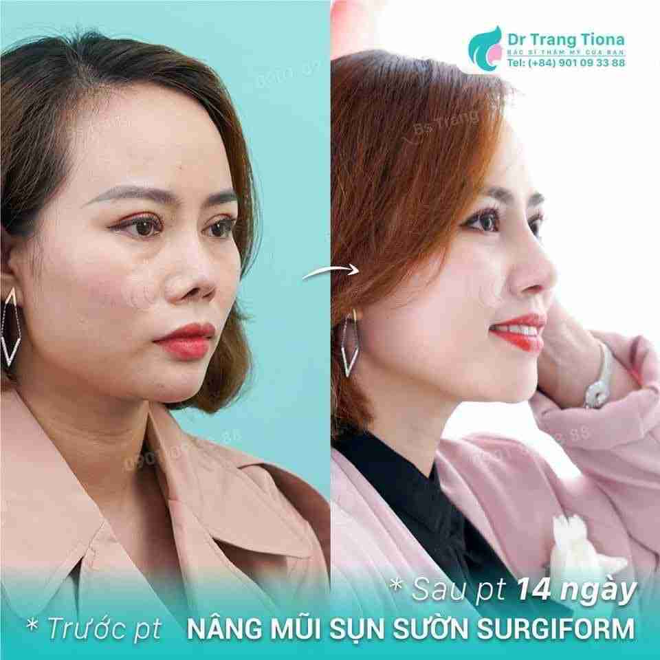 Hình ảnh nâng mũi cấu trúc sau 14 ngày trông như thế nào?