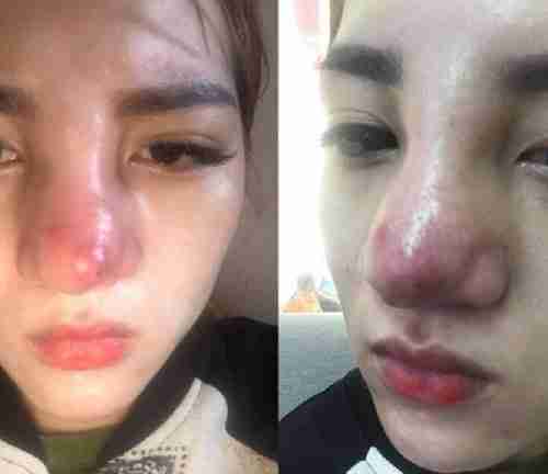 Hút dịch sau nâng mũi có đau không? Làm thế nào?