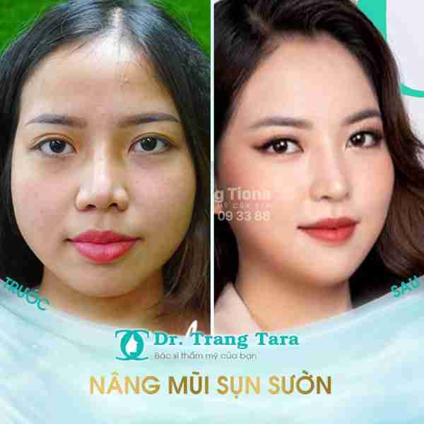 Khắc Phục Mũi Lệch Vẹo