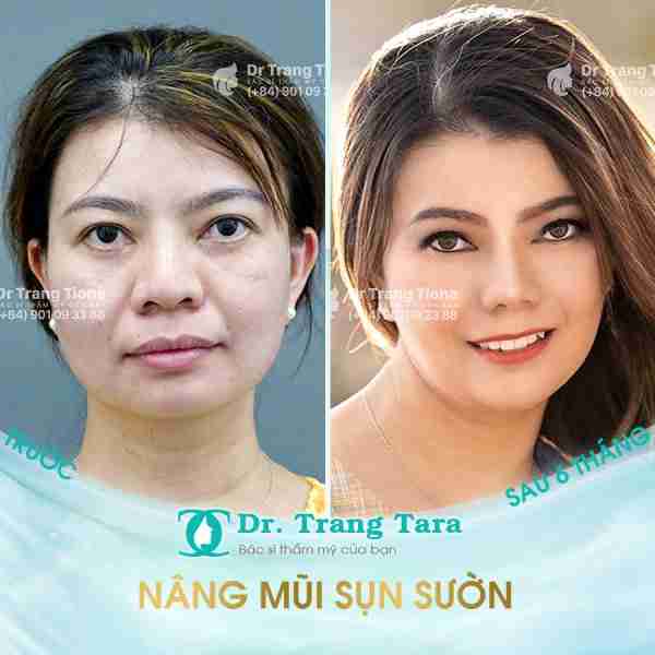Khắc Phục Mũi Lệch Vẹo