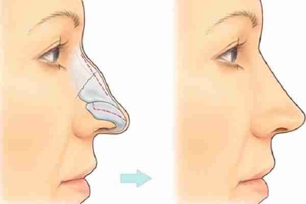Đi tìm cách khắc phục sống mũi gãy hiệu quả