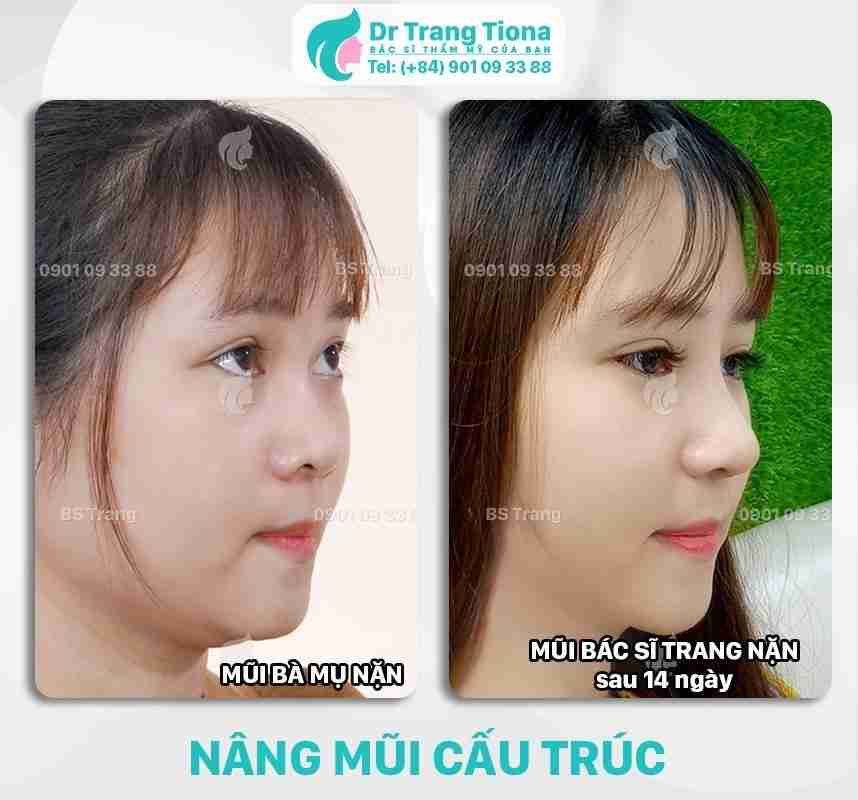Đi tìm cách khắc phục sống mũi gãy hiệu quả