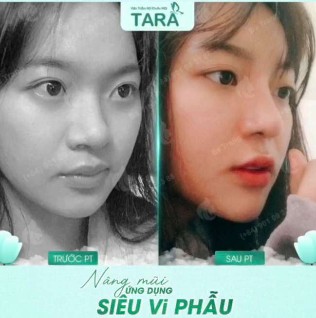 Vai trò của kính lúp trong nâng mũi siêu vi phẫu: “mắt thần” kiến tạo dáng mũi hoàn hảo