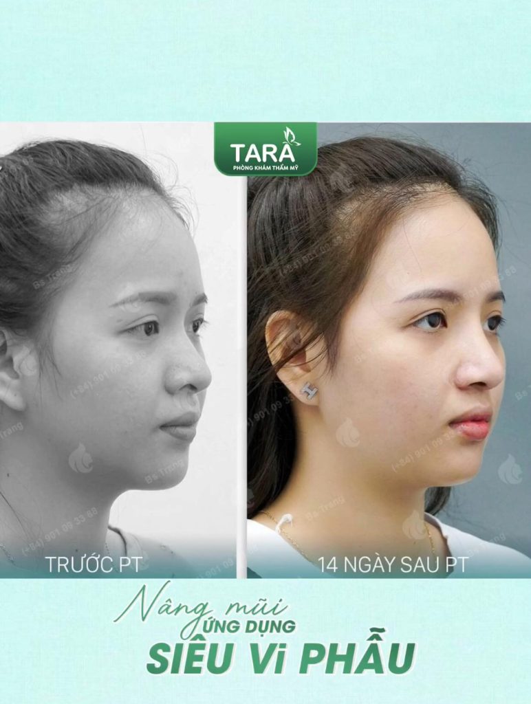 7 Kinh nghiệm chọn bác sĩ nâng mũi giỏi uy tín tại TPHCM