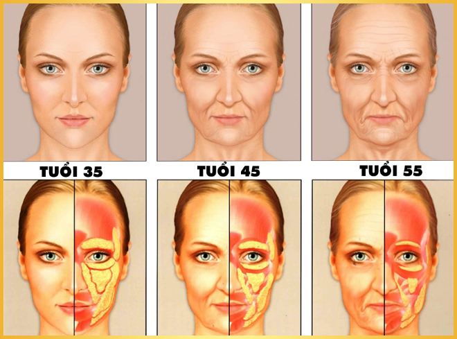 Làm đầy má hõm nhờ cấy mỡ mặt Babyface