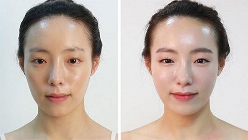 Làm đầy má hõm nhờ cấy mỡ mặt Babyface