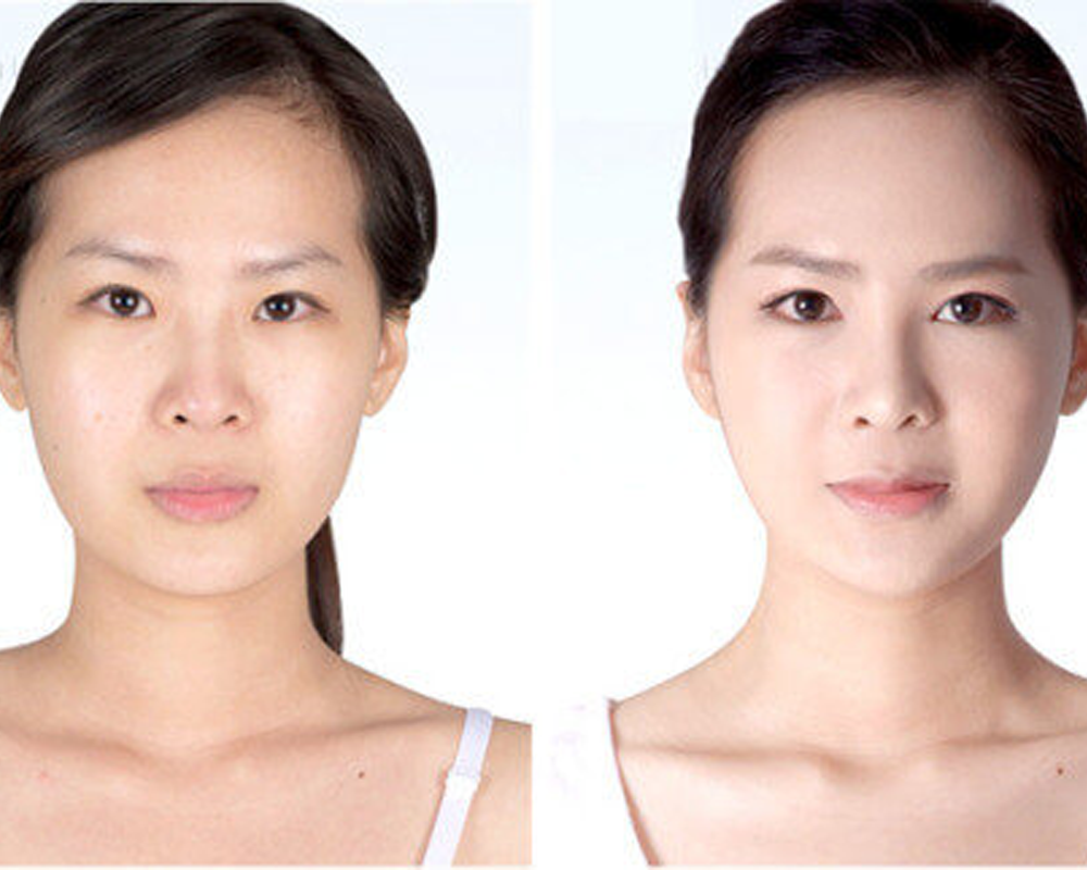 Làm đầy má hõm nhờ cấy mỡ mặt Babyface