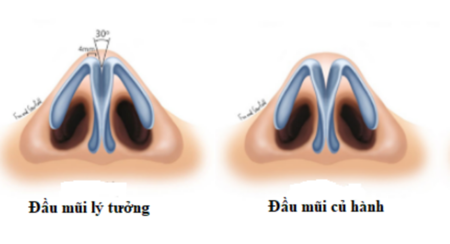Bác sĩ giải đáp: Làm sao để khắc phục mũi củ hành?