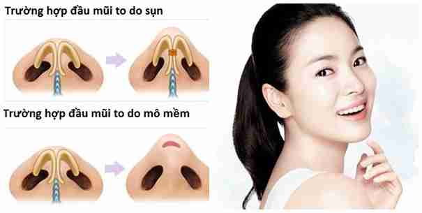 Bác sĩ giải đáp: Làm sao để khắc phục mũi củ hành?