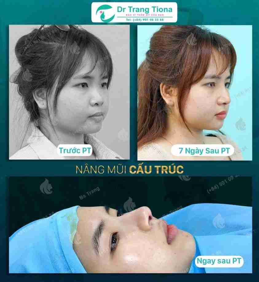 Làm sao để sửa mũi lệch? Giá bao nhiêu?